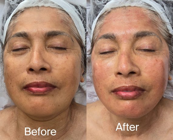 microneedling
